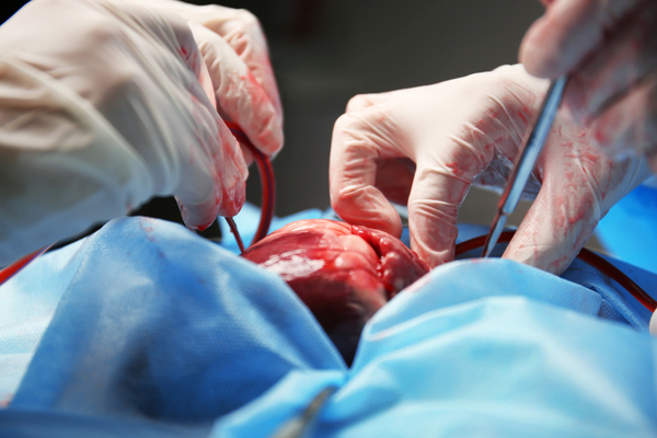 Chirurgie in angina pectorala