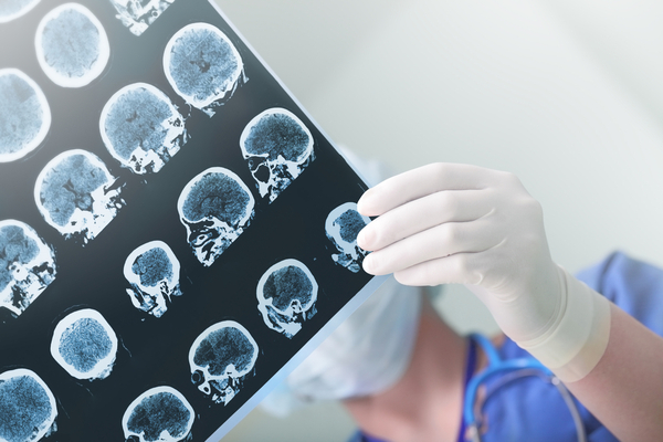 Evaluare pacient dupa accident vascular cerebral RMN